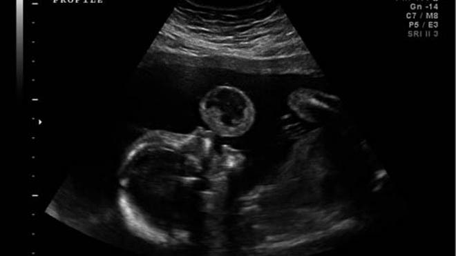 Tumor baby.jpg